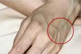 手背“青筋”明显是瘀血阻滞疾病前兆？医生辟谣：这是静脉血管图片