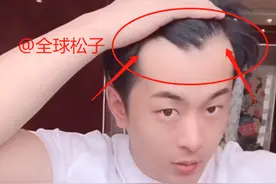压力太大？辛巴直播暴露发量，头发稀少疑似“秃顶”图片