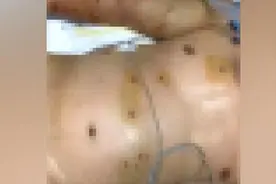 看着都疼！男子全身被马蜂蜇200多处 多器官功能衰竭险丧命视频封面