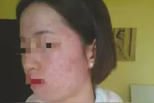 女子花19元体验祛痘 痘没祛除反背上高额“美容贷”图片