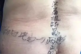 这个哈尔滨大妈治“蛇盘疮”的土方法，把医生要笑死了图片