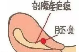 瘢痕子宫再孕 风险不容忽视图片