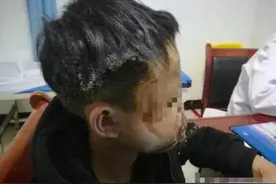 13岁少年燃放鞭炮，遇哑炮意外爆炸面目全非图片