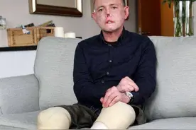 英国男子只因被宠物狗舔了一口，就失去了四肢和鼻子，原因很悲伤图片