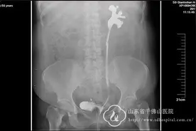 输尿管狭窄患者福音！可植入“永久”输尿管支架图片