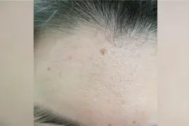 忧伤!90后就开始有了老年斑了?医生提醒大家:可能是肿瘤预警!视频封面