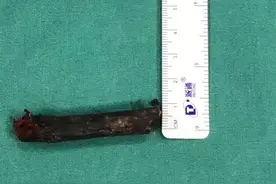 男孩嘴里埋了根树枝，2年来已腐烂发黑！医生都惊呆了！幸亏……图片
