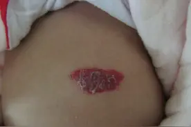 3万网友问：血管瘤能自动消失吗？济南血管瘤医院解答图片