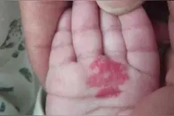 血管瘤会自行消退吗？这些避免面部血管瘤孩子毁容图片
