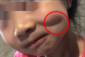 女童幼儿园磕伤脸家长索赔，园方：可起诉视频封面