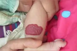 婴儿血管瘤会消退吗？宝妈一看就懂，3秒收藏图片