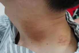 男子家门口按摩刮痧后突然中风，这个部位真的不能随便按图片
