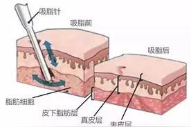 解析大腿吸脂后遗症以及吸脂手术禁忌图片