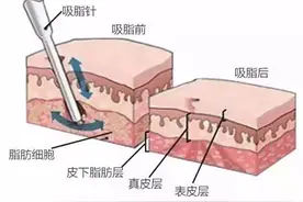 吸脂手术后遗症及其反弹问题是怎么回事？图片