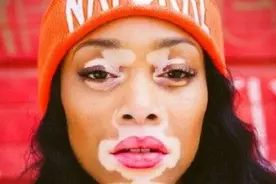 女性白癜风患者能化妆吗？白癜风患者化妆时要注意什么？图片