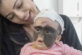 女婴面部黑色胎记像蝙蝠侠面罩，治疗后让母亲惊喜：来俄罗斯对了视频封面