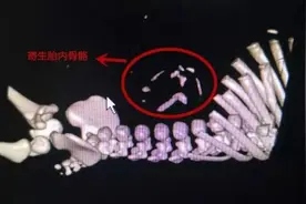 寄生胎藏男婴腹中：已发育9周可见雏形视频封面