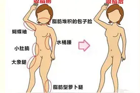 韩啸医生详解大腿吸脂快速瘦腿的并发症及注意事项图片