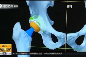 国产机器人助力骨科精准手术,比纸还薄,机器人手术误差仅0.1毫米视频封面