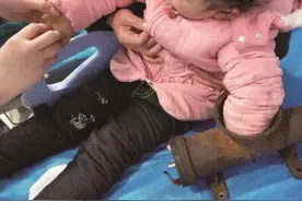 绞肉机“咬”断女童左手，十堰医生8小时再植断手图片