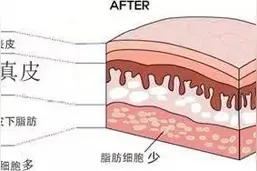 脂肪移植成活率是否会一成不变？图片