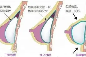 假体隆胸手术有后遗症吗？能避免吗？图片