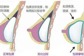 假体隆胸的威胁包膜挛缩你真的了解吗？图片