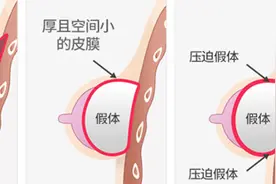 远离包膜挛缩就能够远离丰胸疼痛吗？图片