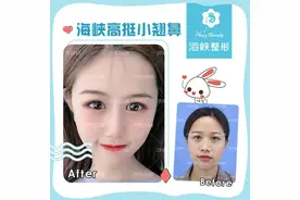 鼻子过短怎么整？图片