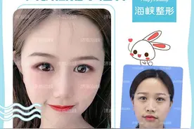 耳软骨隆鼻会被吸收掉吗？图片