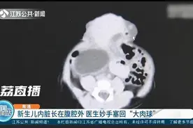 南通一新生儿内脏长在腹腔外似“大肉球”医生妙手塞回图片