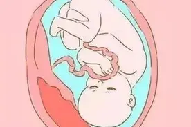 产科医生“谈虎色变”的妊娠严重并发症——胎盘早剥！图片