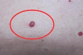身上突然长了很多小红痣是什么原因？图片
