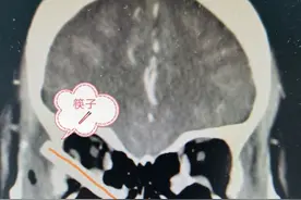 熊孩子玩筷子插入妈妈脑内7厘米，广州医生上演紧急救援图片
