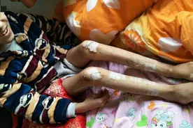 疫情下罕见病群体之困：在家用切割机卸石膏，手术改期特效药暂停图片