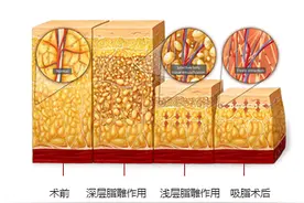 上臂吸脂手术安全吗？术后有没有并发症？图片