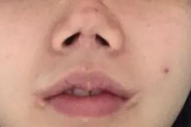 花十几万买来“整容噩梦”：鼻子穿孔、嘴角感染…图片