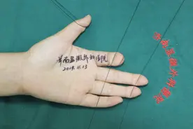 左手示指末节缺损30多年，14个小时就帮她圆了梦图片
