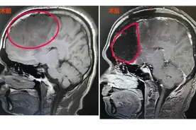 男子突然癫痫发作竟是因为脑肿瘤，这样做可提高生存质量图片