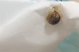 泉州：“臭鼻子”困扰男童3年 竟是异物藏鼻腔图片