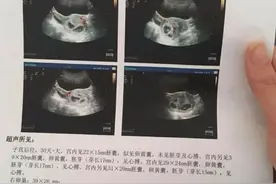 浙江男子带老婆做孕检，一查肚子里竟有4个...网友算了笔帐，一般人真不知道图片