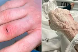 手指划了个小口子 英国男子整只手溃烂图片