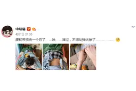 钟楚曦晒照称腰韧带损伤一个月 背上扎满针难动弹图片