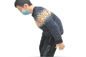 患强直性脊柱炎 男子驼背畸形 手术后弯了17年的腰直了图片