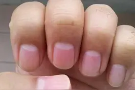 指甲出现这些情况，可能是体内疾病发出的信号，还请及时就诊图片
