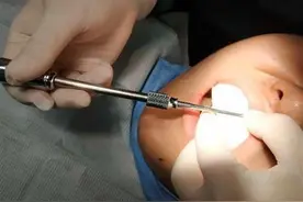 网购隐形牙套DIY，权威正畸专家说NO图片