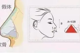 隆鼻有哪些副作用？小心这5大后遗症等着你图片