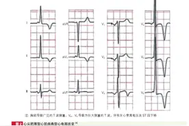 一文让你学会看心尖肥厚型心肌病的心电图图片