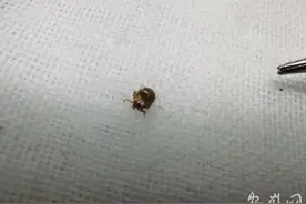 蜱虫钻进八岁男孩头顶 专家提醒：身上冒出小黑点别大意图片