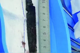 断刃藏颅脑26年 老人从青海来济南成功手术图片